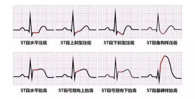 心电图912什么意思读懂心电图上的“弯弯绕绕”-上海聚慕医疗器械有限公司