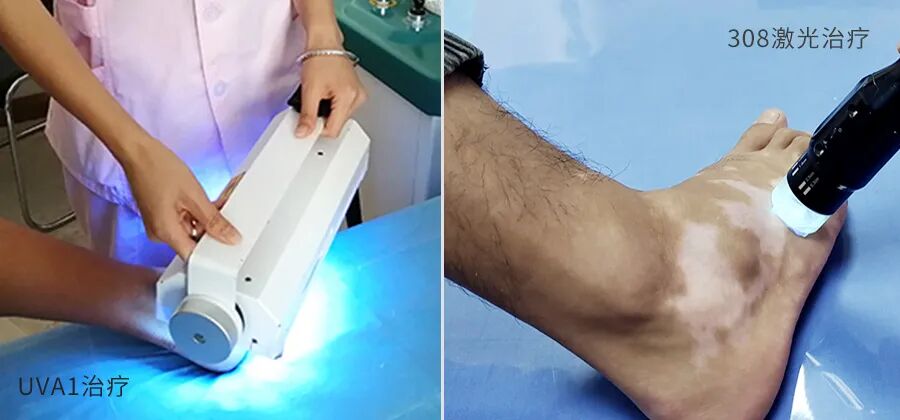 4006B光疗怎么用不同部位的白癜风光疗的选择也不同！快看看你用对了吗？_https://www.jmylbn.com_新闻资讯_第5张