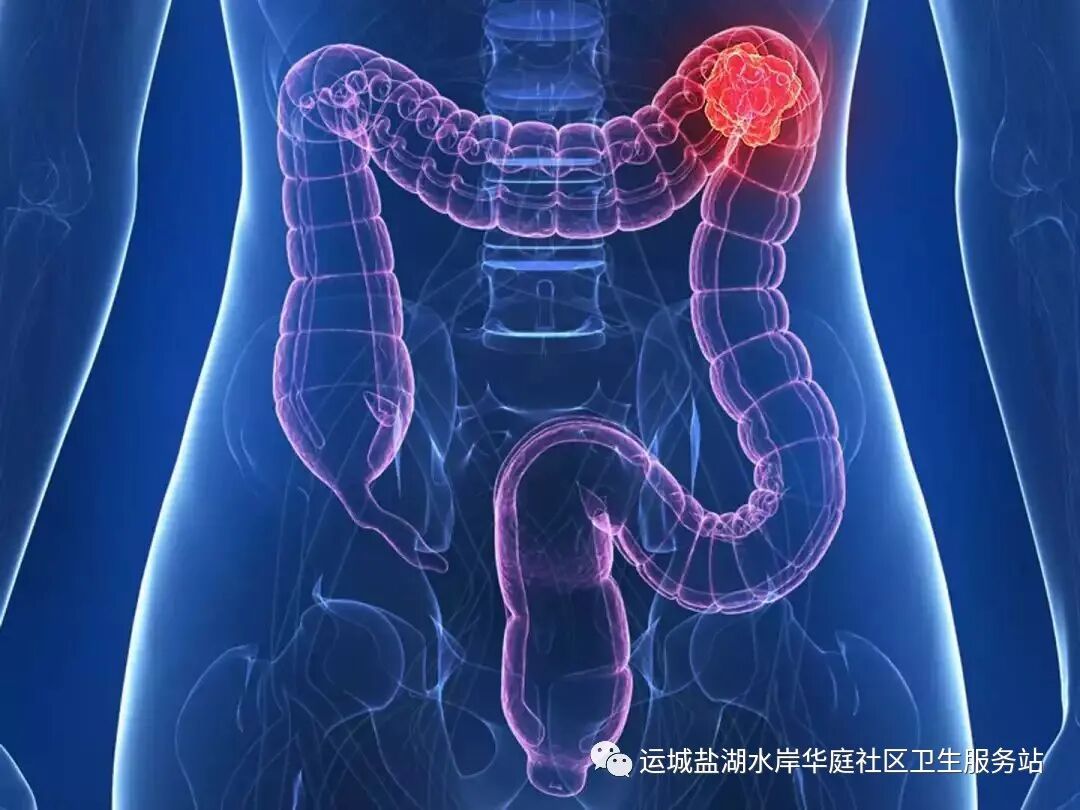 大肠癌的早期症状 五个信号千万别忽视 全网搜