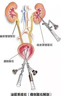 输尿管软镜有什么品牌输尿管镜还分软硬？_https://www.jmylbn.com_新闻资讯_第8张