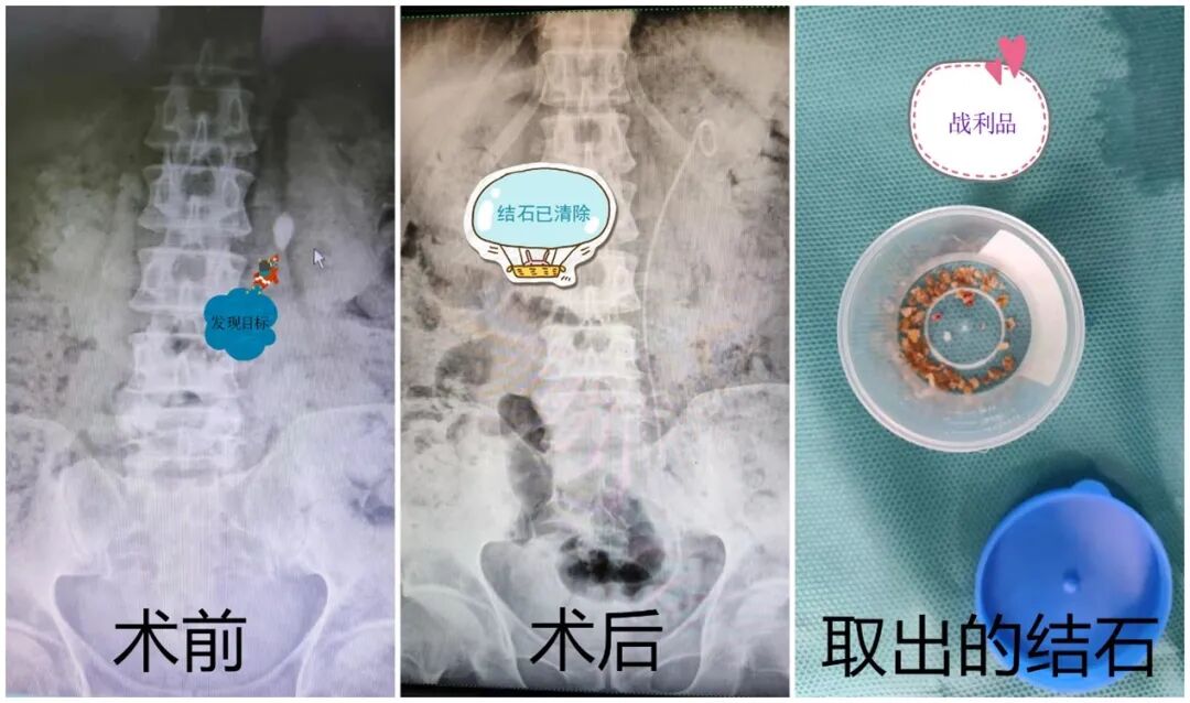 输尿管软镜有什么品牌输尿管镜还分软硬？_https://www.jmylbn.com_新闻资讯_第9张