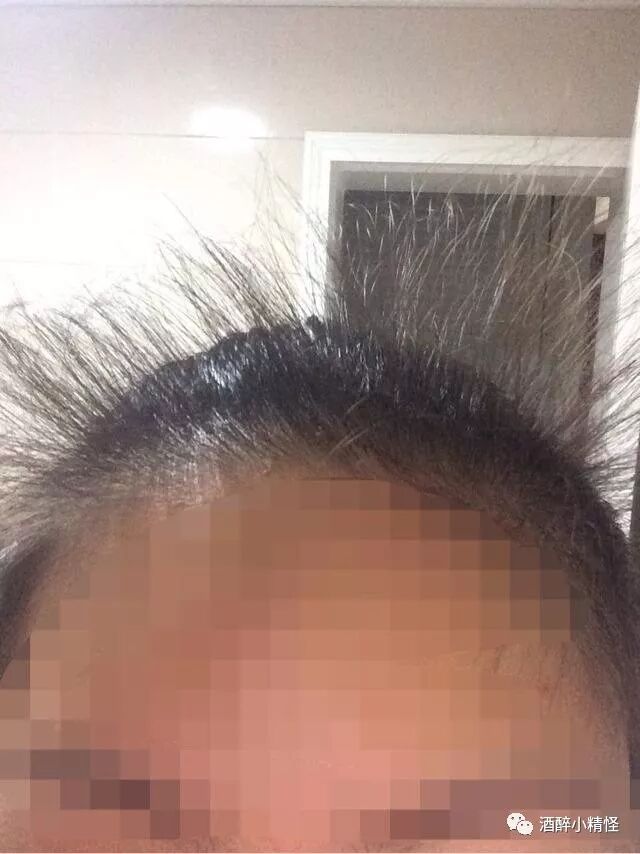 秃头日记五个月战秃顶.....