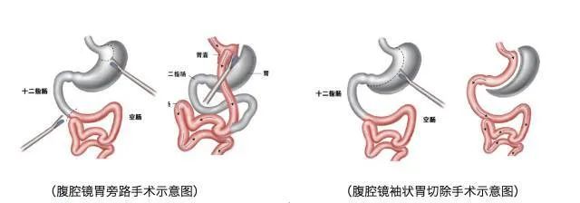 手术减肥_减肥手术是怎么做的_减肥手术有什么危害