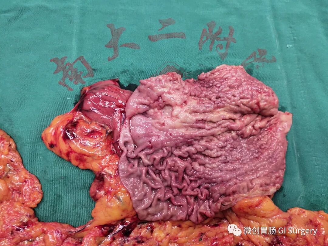 borrmann iv型(弥漫型)胃癌的诊治_医学界-助力医生临床决策和职业