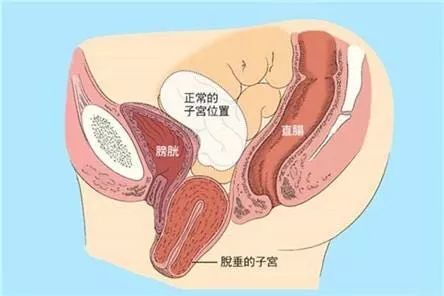 產後過早瘦身，易導致子宮脫垂 運動 第3張