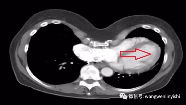 图10，前胸壁凹陷时，尽管凹陷对称存在，心脏却被挤压到左侧胸腔，从而