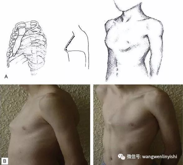 鸡胸的最新分类方法