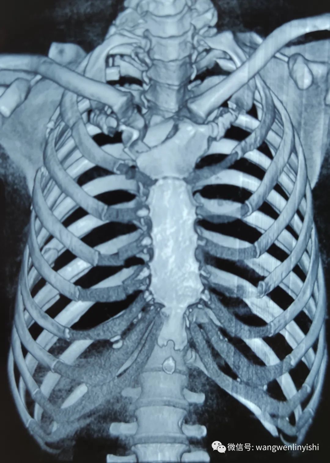 西藏地区第一台数字材料胸壁重建手术 胸廓畸形手术专家 微信公众号文章阅读 Wemp