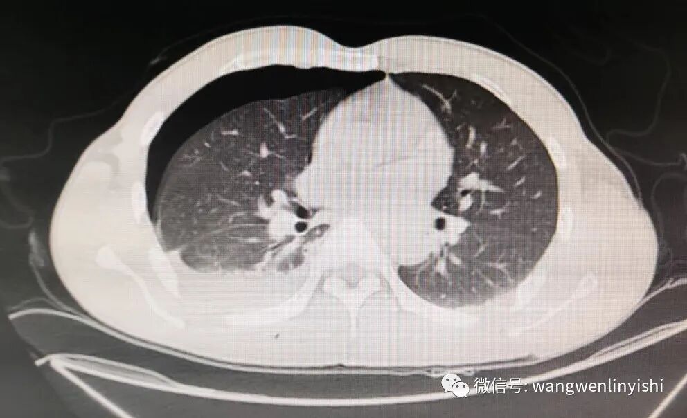 肋骨固定板怎么拆MatrixRIB最新固定方法：在粉碎性肋骨骨折手术中的应用_https://www.jmylbn.com_新闻资讯_第3张