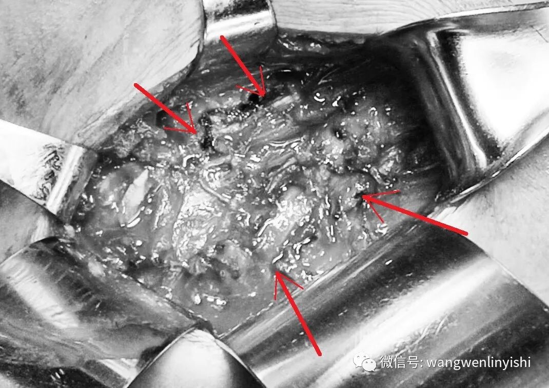 肋骨固定板怎么拆MatrixRIB最新固定方法：在粉碎性肋骨骨折手术中的应用_https://www.jmylbn.com_新闻资讯_第5张
