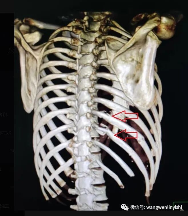 肋骨固定板怎么拆MatrixRIB最新固定方法：在粉碎性肋骨骨折手术中的应用_https://www.jmylbn.com_新闻资讯_第4张