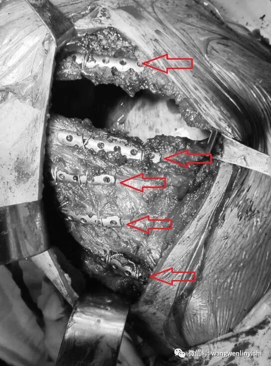 肋骨固定板怎么拆MatrixRIB最新固定方法：在粉碎性肋骨骨折手术中的应用_https://www.jmylbn.com_新闻资讯_第6张