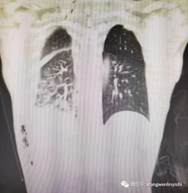 肋骨固定板怎么拆MatrixRIB最新固定方法：在粉碎性肋骨骨折手术中的应用_https://www.jmylbn.com_新闻资讯_第2张