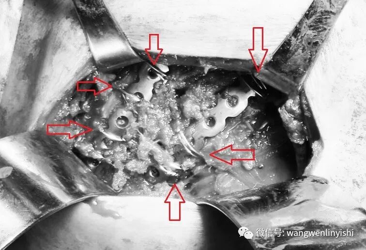 肋骨固定板怎么拆MatrixRIB最新固定方法：在粉碎性肋骨骨折手术中的应用_https://www.jmylbn.com_新闻资讯_第7张