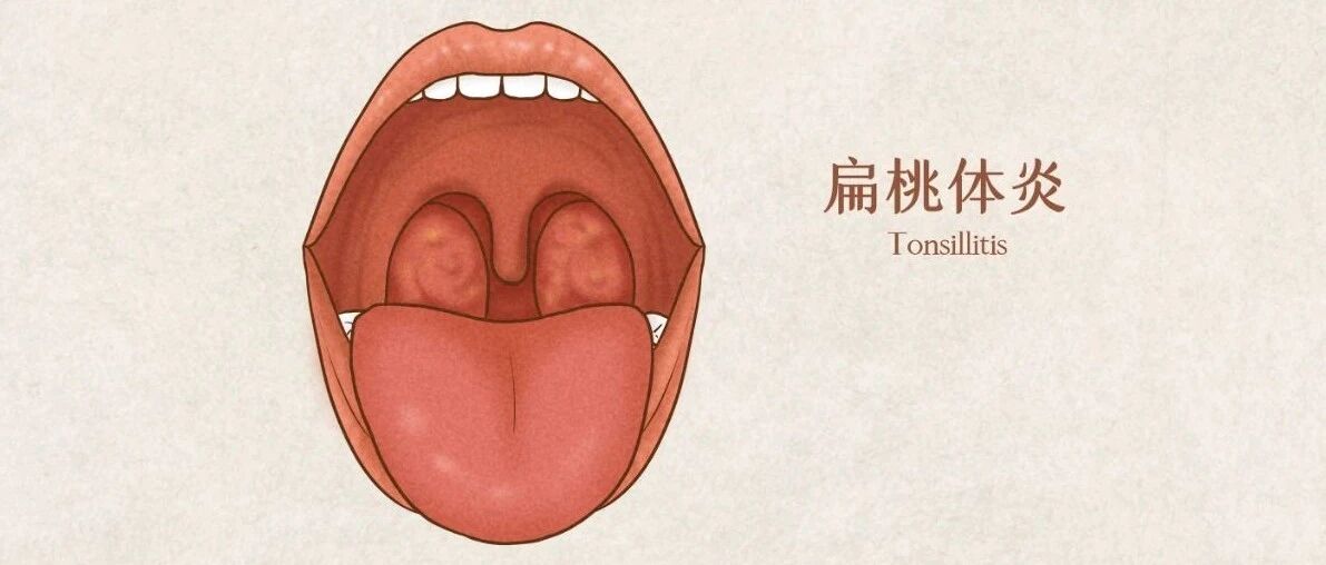 扁桃体发炎要不要割？主要看这几种情况
