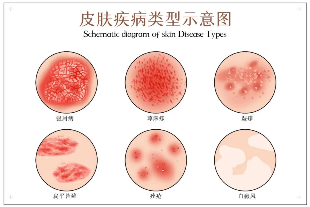 湿疹皮肤病对照图图片