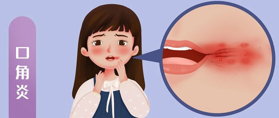 假期过完“烂嘴角”、口腔溃疡？这些方法帮到你！