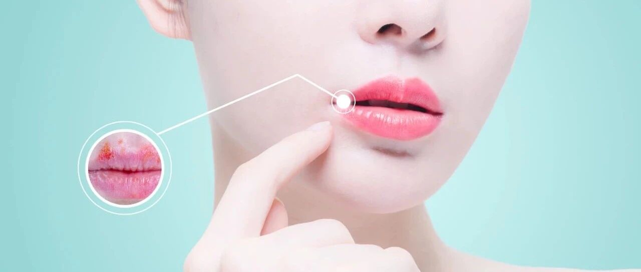 “口腔溃疡”小心越清热越烂！这两种人特别要注意了！