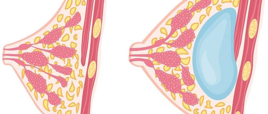 夏季竟是乳房疾病高发季？别怕！专家教你预防及自检！