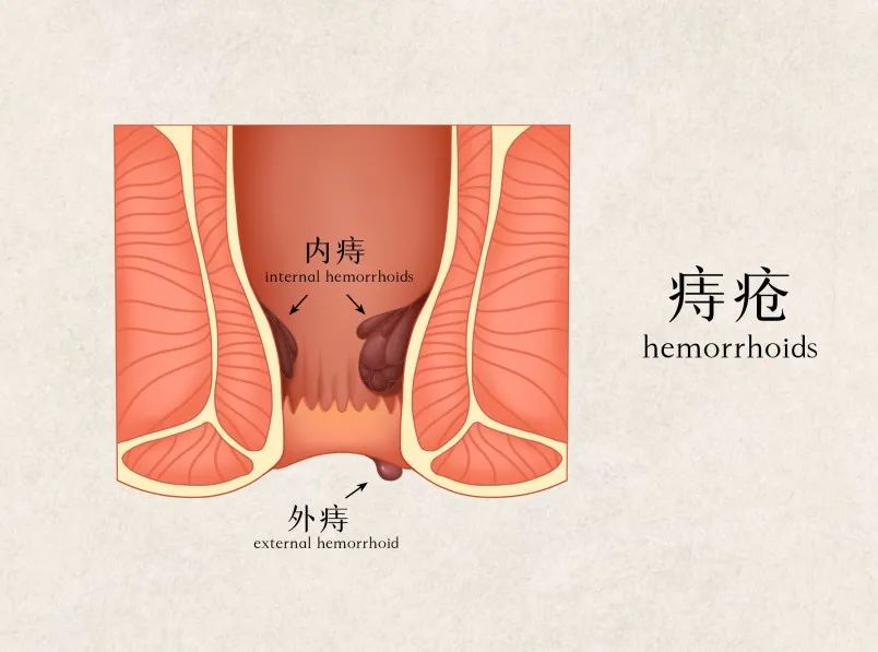 出血可见血液附着在大便上,或是厕纸上;脱出则是痔疮从肛门内露出到
