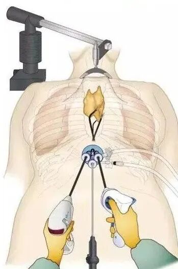 手术耗材是什么医加百科｜胸腹腔镜手术器械耗材介绍_https://www.jmylbn.com_新闻资讯_第1张