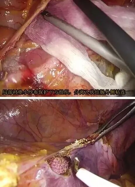 纱布怎么止血手术室不可缺少的耗材，速即纱的妙用_https://www.jmylbn.com_新闻资讯_第5张