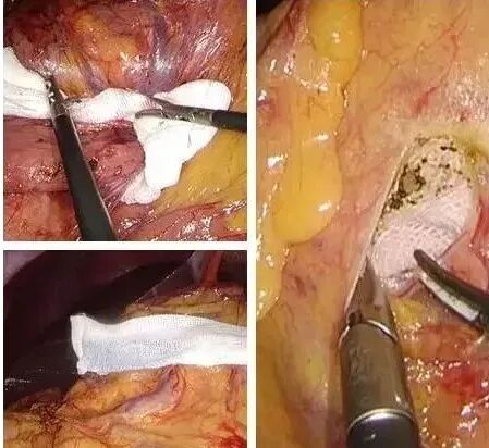 纱布怎么止血手术室不可缺少的耗材，速即纱的妙用_https://www.jmylbn.com_新闻资讯_第7张