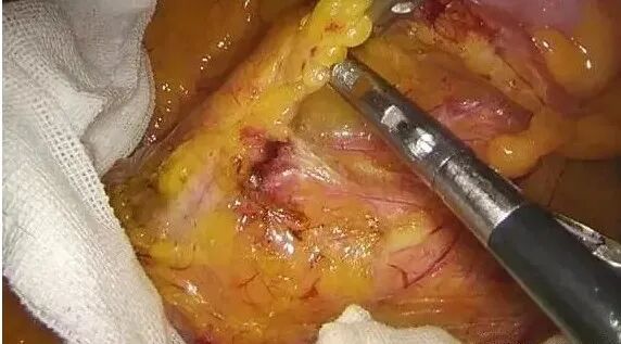 纱布怎么止血手术室不可缺少的耗材，速即纱的妙用_https://www.jmylbn.com_新闻资讯_第9张