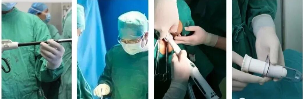 吻合器怎么用的医加百科：吻合器的种类及应用_https://www.jmylbn.com_新闻资讯_第2张