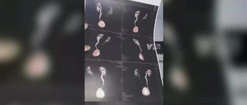 驻马店男子去医院看肾结石，结果发现自己有3个肾！医生：不稀奇，还有“四个肾”的！