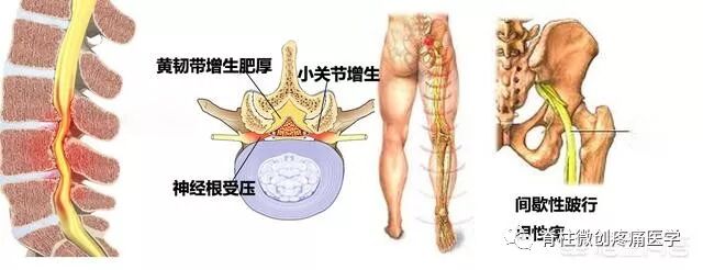 得了腰椎管狭窄会出现怎样的症状 根治坐骨神经疼 微信公众号文章阅读 Wemp