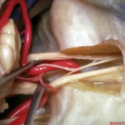 外展枕怎么使用脑干解剖及相关入路---Rhoton解剖视频学习笔记系列_https://www.jmylbn.com_新闻资讯_第274张