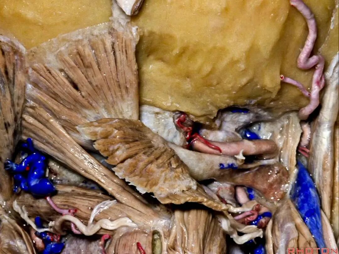 外展枕怎么使用脑干解剖及相关入路---Rhoton解剖视频学习笔记系列_https://www.jmylbn.com_新闻资讯_第319张