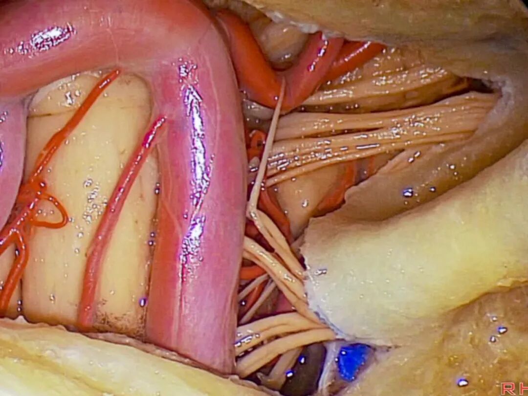 外展枕怎么使用脑干解剖及相关入路---Rhoton解剖视频学习笔记系列_https://www.jmylbn.com_新闻资讯_第340张