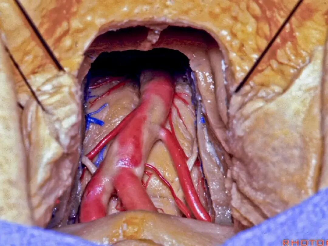 外展枕怎么使用脑干解剖及相关入路---Rhoton解剖视频学习笔记系列_https://www.jmylbn.com_新闻资讯_第314张
