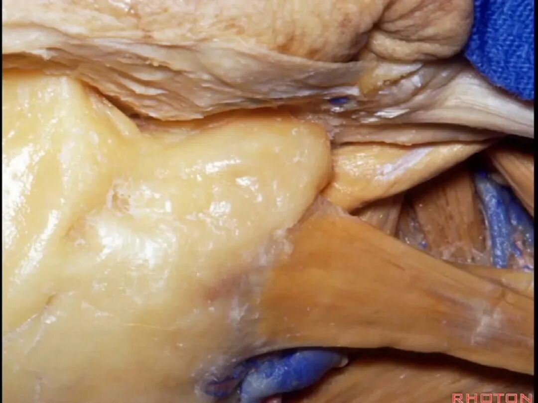 外展枕怎么使用脑干解剖及相关入路---Rhoton解剖视频学习笔记系列_https://www.jmylbn.com_新闻资讯_第278张