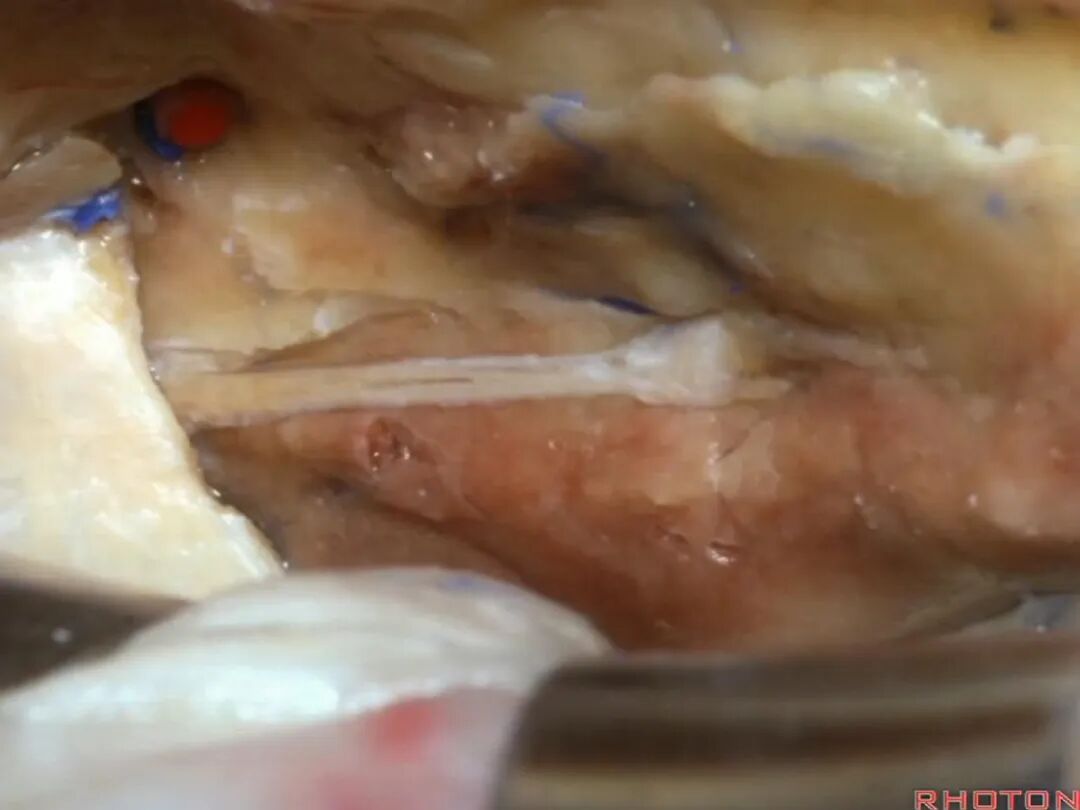 外展枕怎么使用脑干解剖及相关入路---Rhoton解剖视频学习笔记系列_https://www.jmylbn.com_新闻资讯_第187张