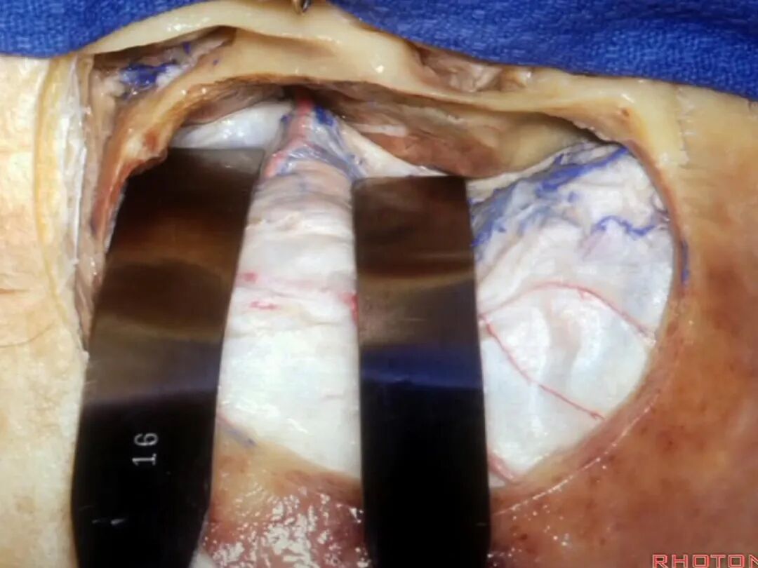 外展枕怎么使用脑干解剖及相关入路---Rhoton解剖视频学习笔记系列_https://www.jmylbn.com_新闻资讯_第186张