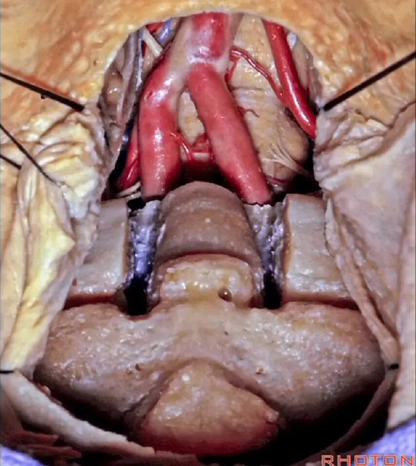 外展枕怎么使用脑干解剖及相关入路---Rhoton解剖视频学习笔记系列_https://www.jmylbn.com_新闻资讯_第315张
