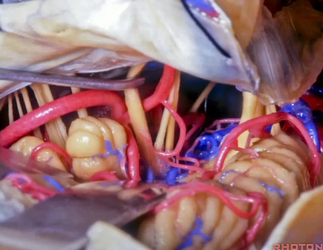 外展枕怎么使用脑干解剖及相关入路---Rhoton解剖视频学习笔记系列_https://www.jmylbn.com_新闻资讯_第297张