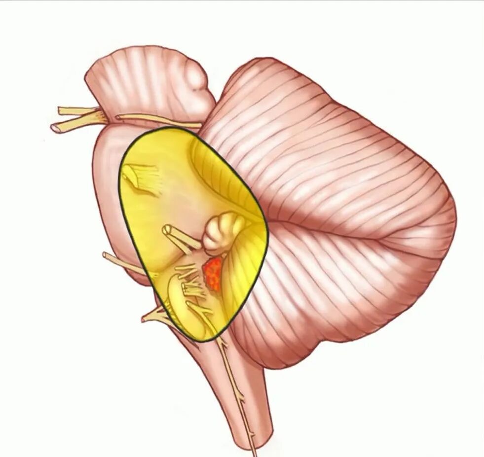 外展枕怎么使用脑干解剖及相关入路---Rhoton解剖视频学习笔记系列_https://www.jmylbn.com_新闻资讯_第92张