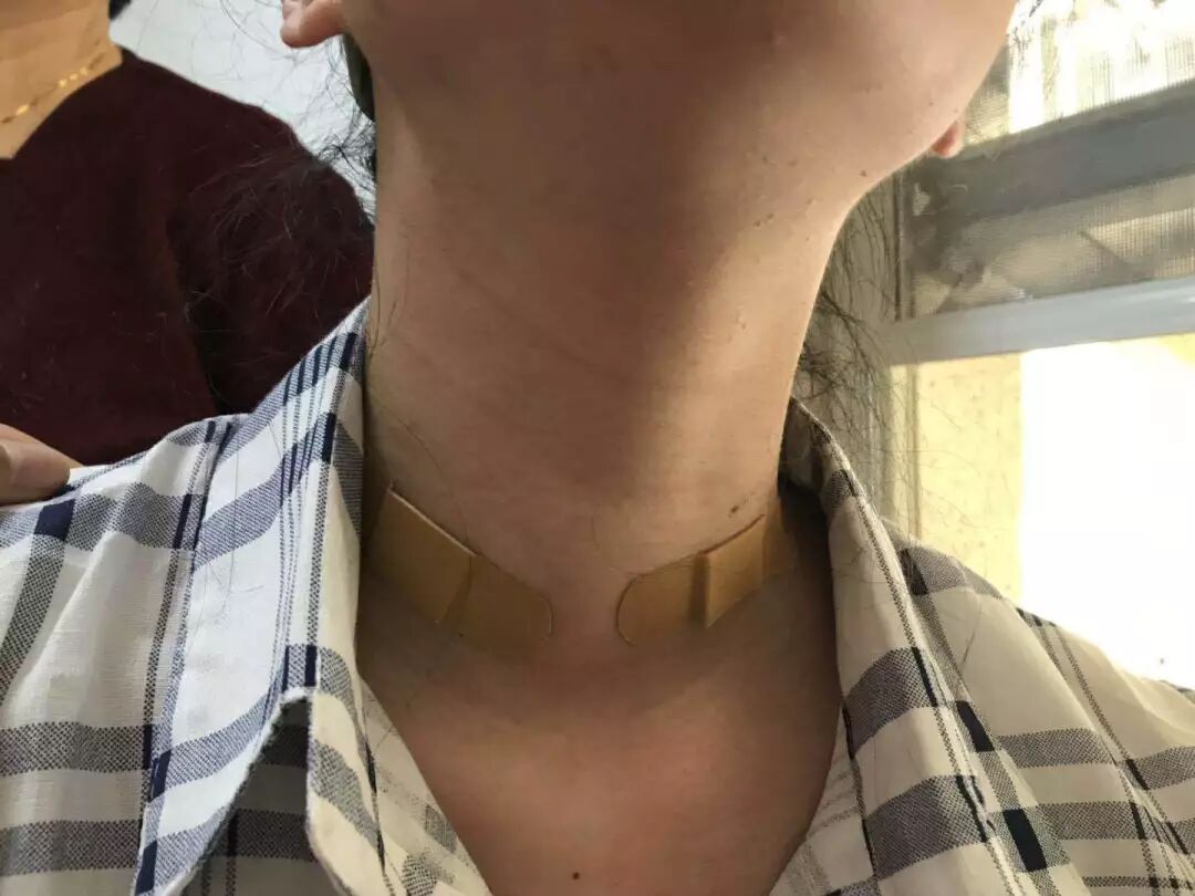 甲亢患者的脖子图片_甲亢脖子和正常脖子图片_甲亢大脖子图片