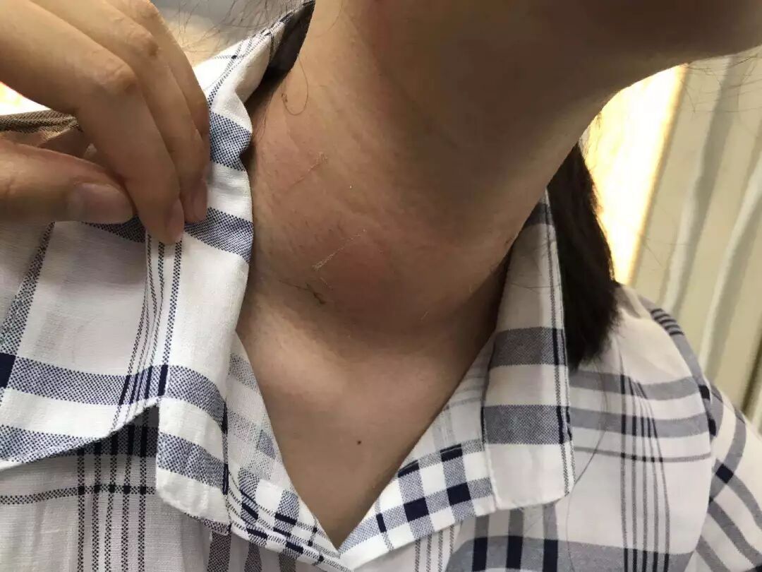 甲亢脖子和正常脖子图片_甲亢患者的脖子图片_甲亢大脖子图片