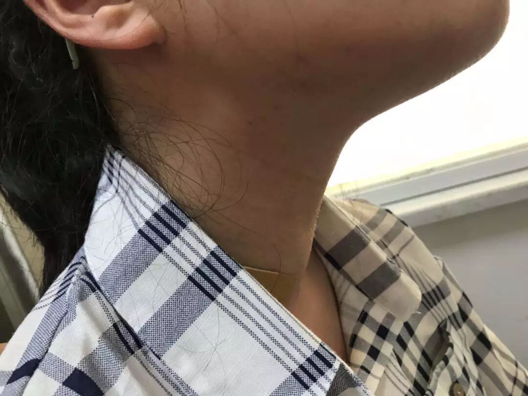 甲亢脖子和正常脖子图片_甲亢患者的脖子图片_甲亢大脖子图片