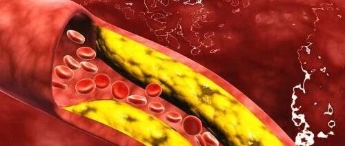 听说血管里有“垃圾”？还得疏通--你以为是下水道呀！