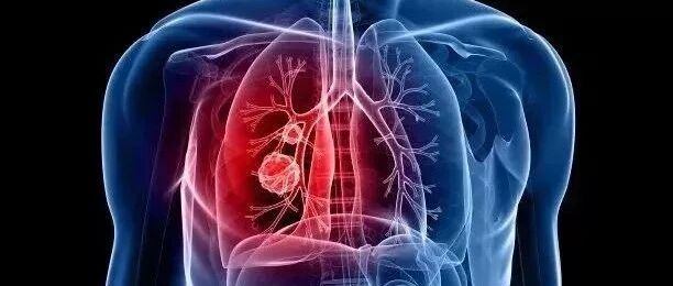 体检发现肺结节，我是不是要死了？