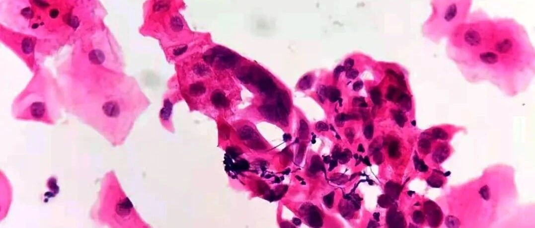 病理科干检验的活儿？宫颈细胞学中为什么要报告病原微生物？