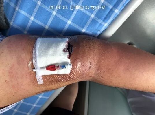 怎么撕敷料啊PICC：0°揭敷料，Ω固定法，好经验快收藏！_https://www.jmylbn.com_新闻资讯_第2张