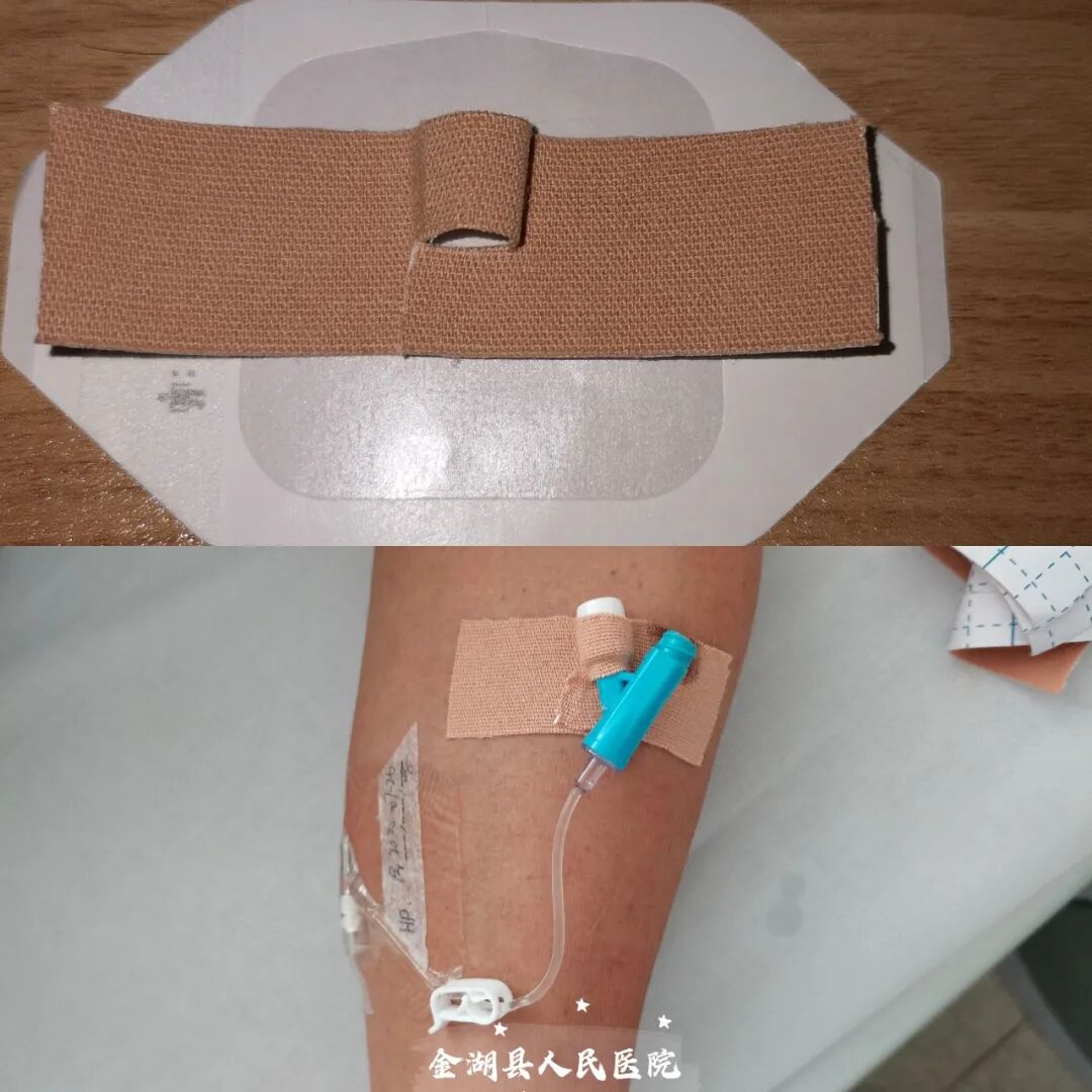体表导管固定怎么使用护士巧用3M胶布制作了各类型的导管固定贴（安心贴）_https://www.jmylbn.com_新闻资讯_第5张