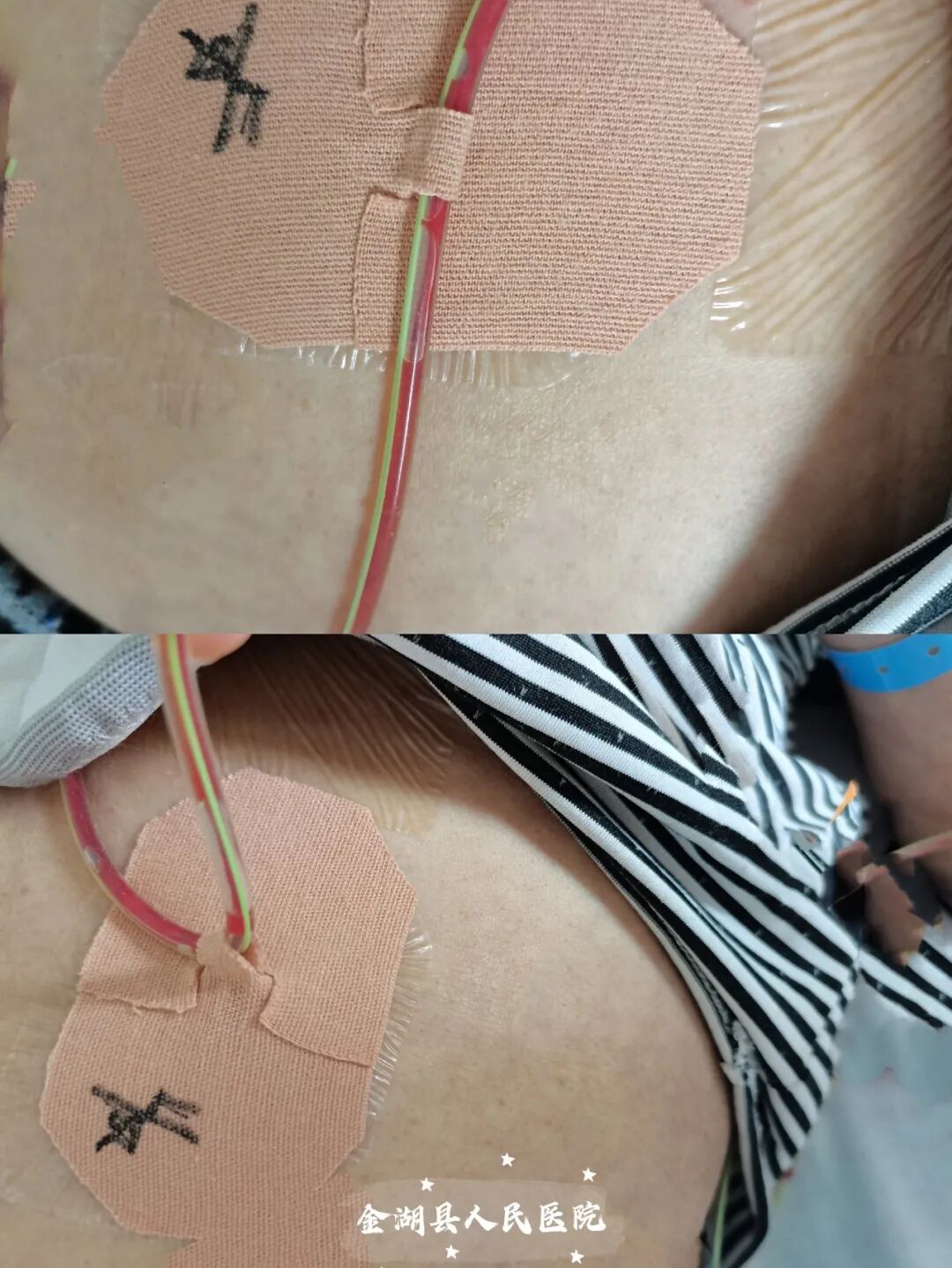 体表导管固定怎么使用护士巧用3M胶布制作了各类型的导管固定贴（安心贴）_https://www.jmylbn.com_新闻资讯_第6张